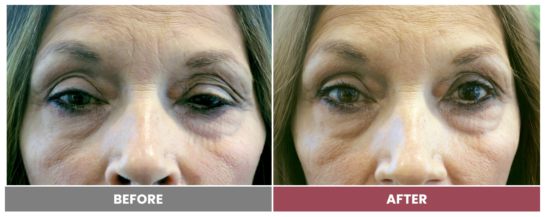 PTOSIS REPAIR - Case 68